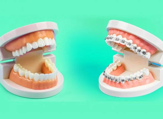 Clear Aligners vs Kawat Gigi Logam